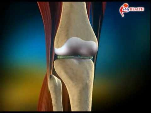 Video: 3 Cara Merawat Fasciitis Plantar