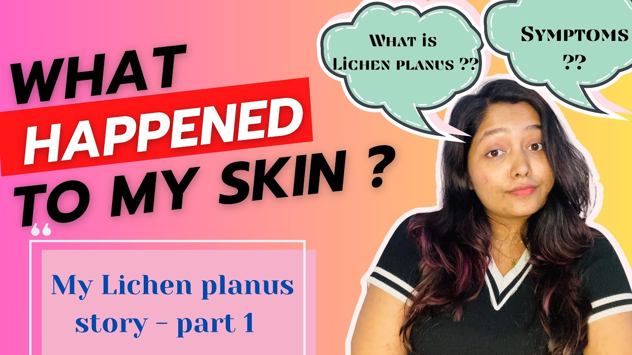 lichen-planus-pigmentosus-what-is-lichen-planus-it-s-symptoms-my