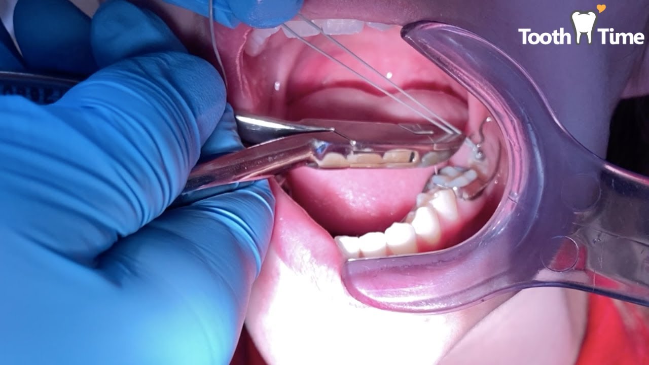 Orthodontic Traction for Impacted Second Mandibular molar Tooth Time