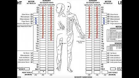 Classifying Spinal Cord Injuries using ASIA Scoring [Example 2]