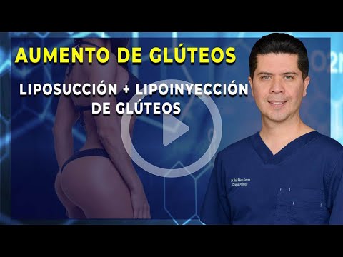 Aumento de glúteos | Liposucción + Lipoinyección de glúteos | Dr. Raúl Pérez Cerezo.