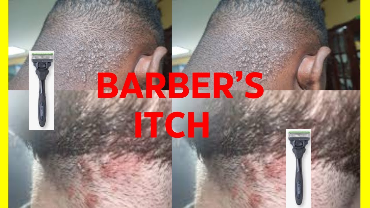 BARBER'S ITCH: WHY THE ITCH - YouTube