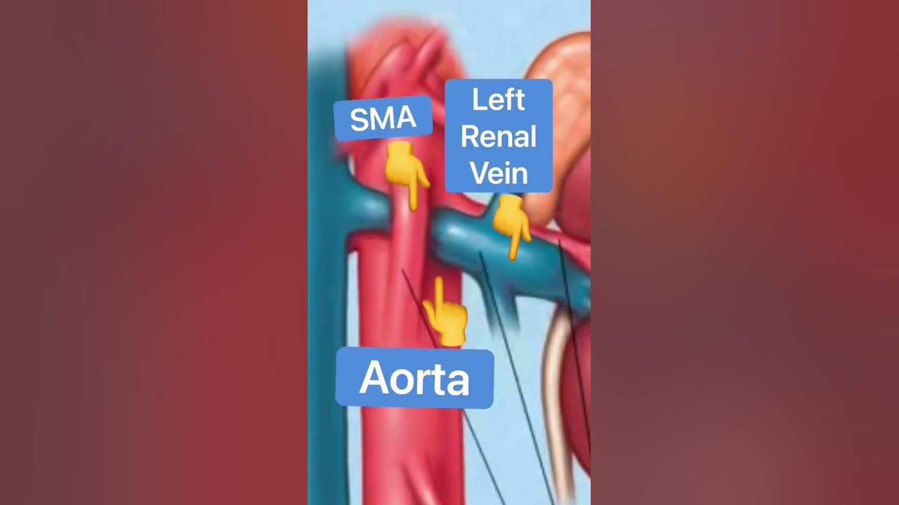 Post Ghost of Christmas Past Nutcracker Syndrome YouTube