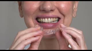 Invisalign® and Other Clear Aligners