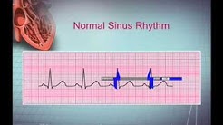 Intro EKG Interpretation Part 1 - Durasi: 8.17. 