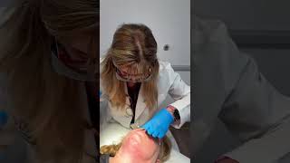 Laser is always one of the best options for the skin