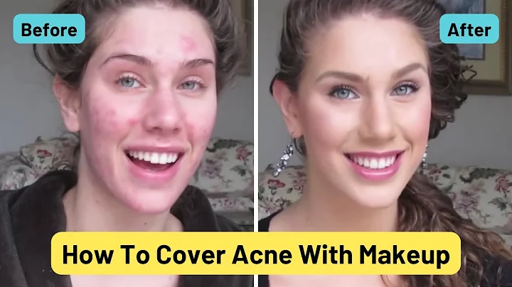 Foundation Routine For Acne | How To Cover Pimples...