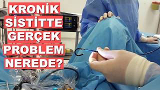 Kronik Sistit Tedavi Başarısında Önemli Detay: Fulgurasyon Yapılıyor Ama Neden Tam İyileşme Olmuyor?
