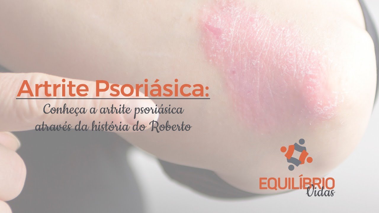 Artrite Psoriásica: conheça a artrite psoriásica através da história do Roberto.