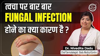 Fungal Infection on Skin | Complete Treatment of Fungal Infections Fungal Infection on Skin | Complete Treatment of Fungal Infections