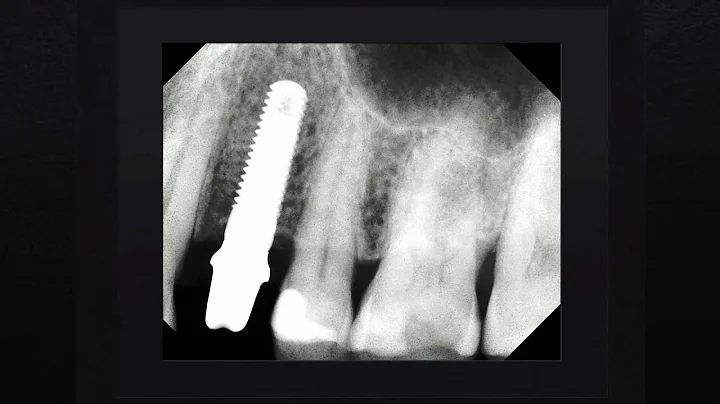Dental Implants Austin TX | Call Us: (512)379-5752