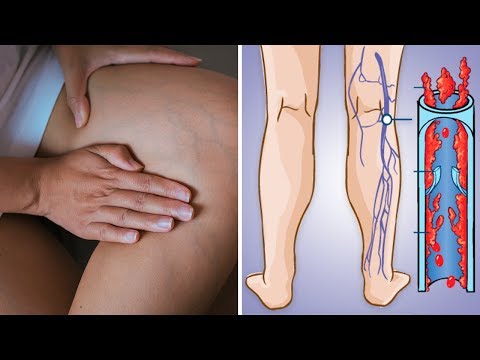 Coágulos de Sangue: Como Evitar? Coágulos de Sangue: Como Evitar?