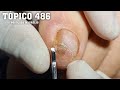 UNHAS ENCRAVADA !! (INGROWN TOENAILS) - PODÓLOGO MAURÉLIO