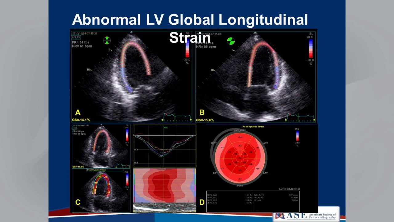 global longitudinal strain echo