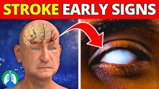 Top 10 Early Warning Signs of a Stroke You MUST Know