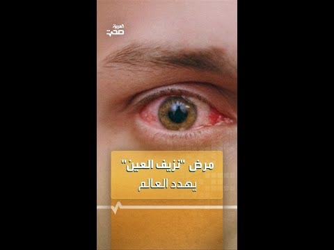 توقعات مخيفة حول انتشار مرض نزيف العين عالميا