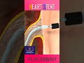 Heart Stent Placement #shorts