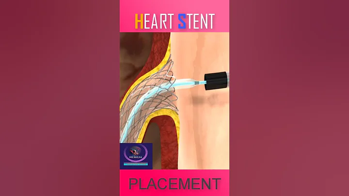 Heart Stent Placement #shorts
