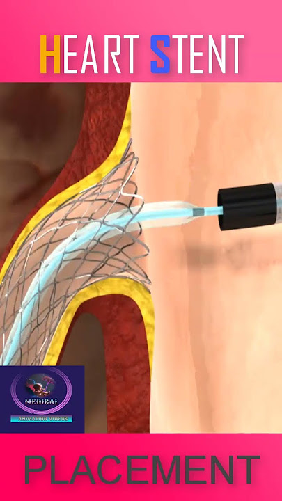 Heart Stent Placement #shorts