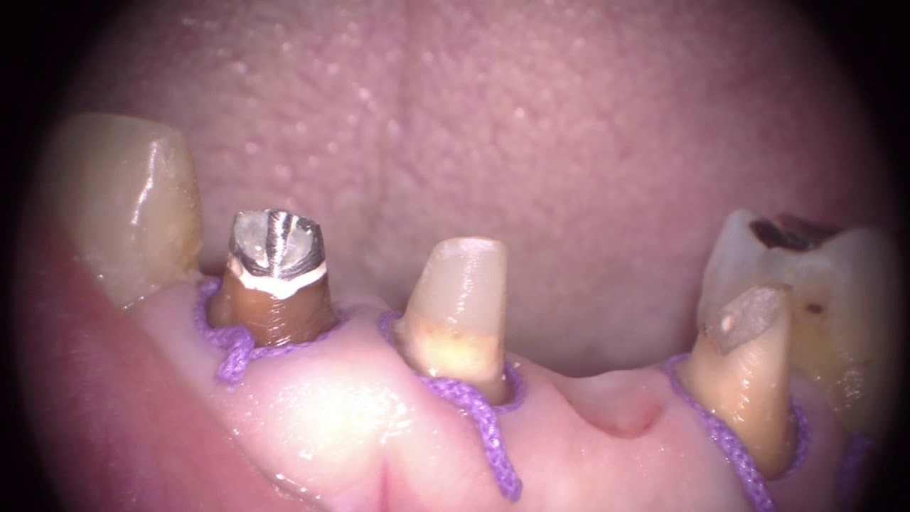 前歯印象の為の歯肉圧排 Gingival retraction for impression. YouTube
