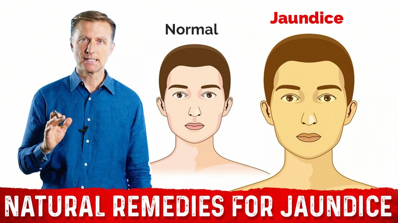 What is Jaundice? – Causes & Treatment Covered by  - YouTube