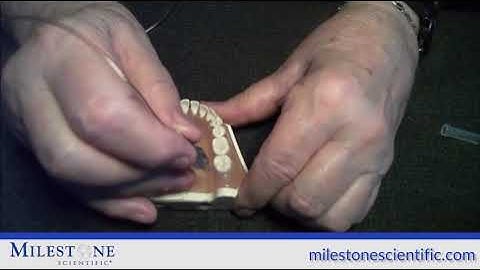 MLSS - Crestal Injection with the STA System (Wand STA)