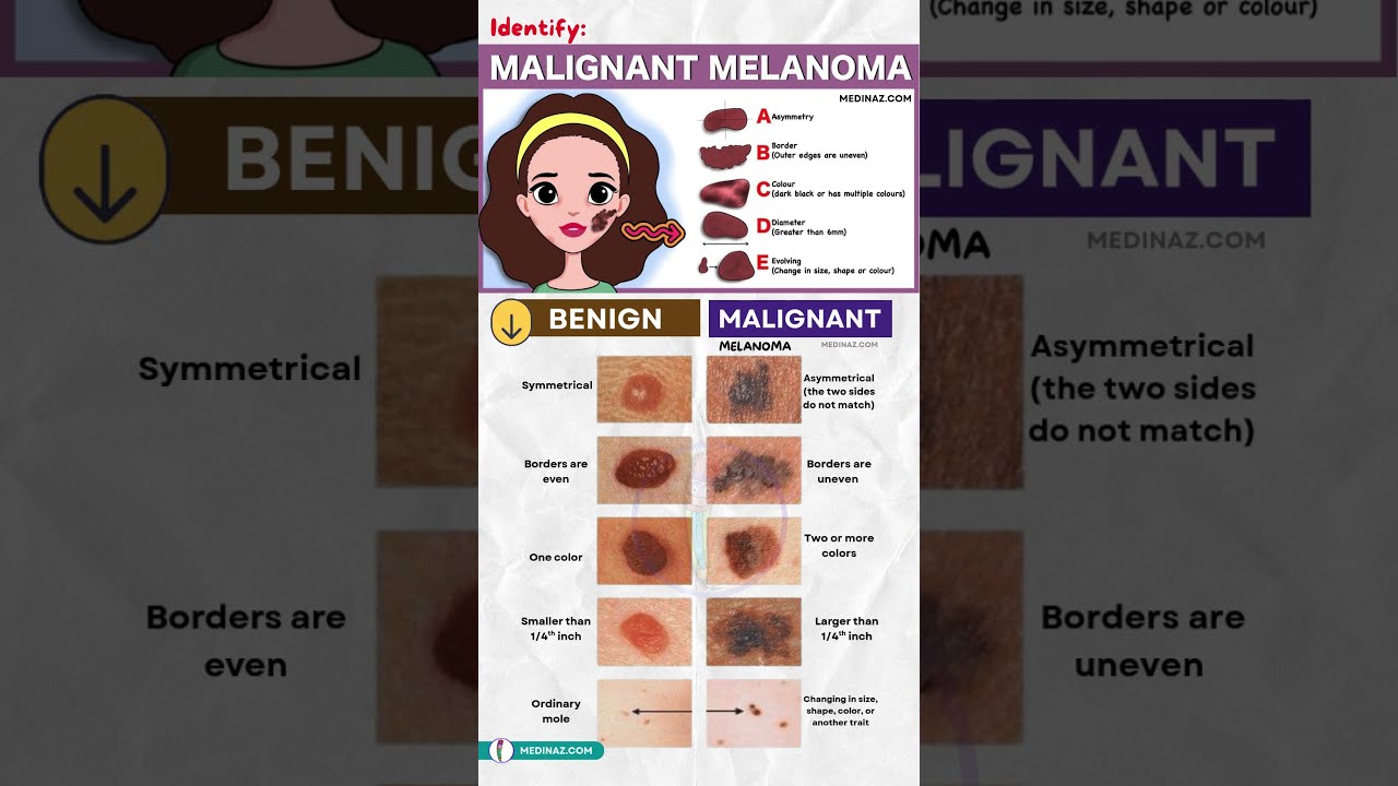 How To Identify Melanoma Skin Cancer Early Signs