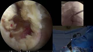 Full-endoscopic Spine Surgery interlaminar approach performed by Dr. K. Nwosu, Neospine Seattle USA