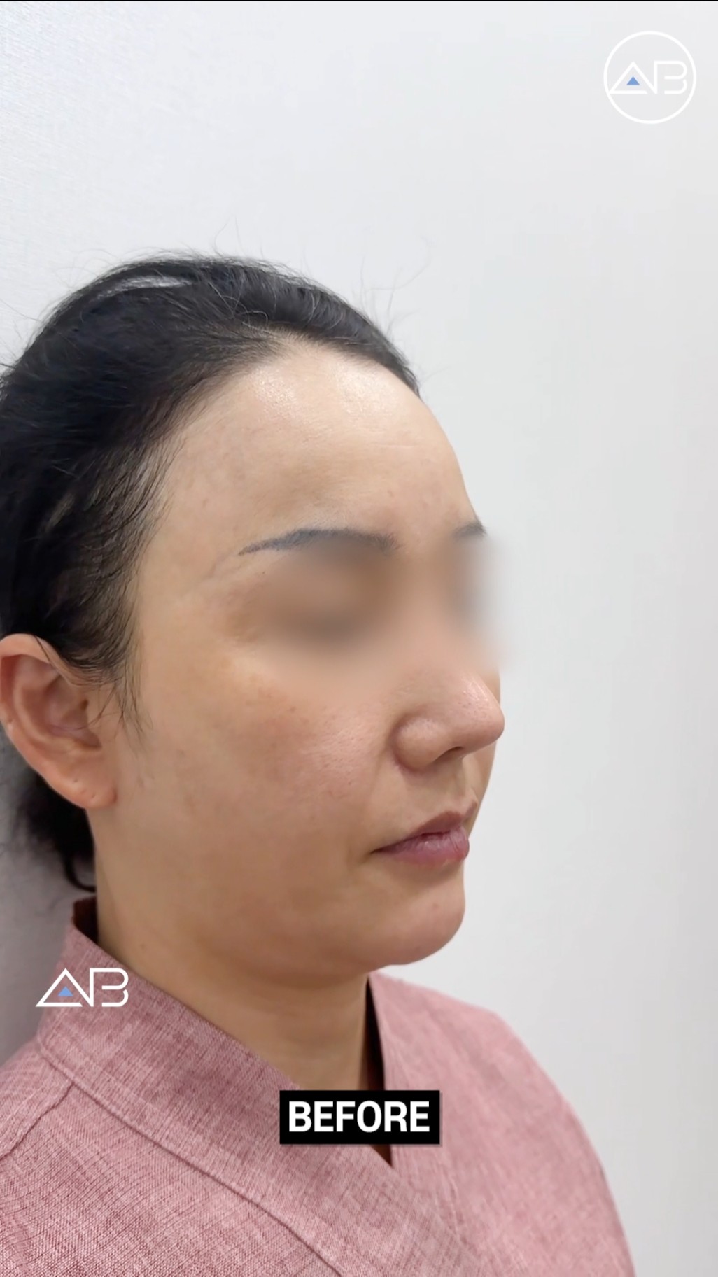 Youth Restored: The Full Face Lift Effect Revealed! #shorts
