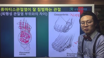 류마티스관절염(RA)와 퇴행성관절염(OA)의 차이 : 발, 발가락
