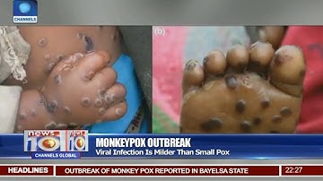 As it Happened UK : Monkeypox Cases Rise To 57, What is monkeypox New Update