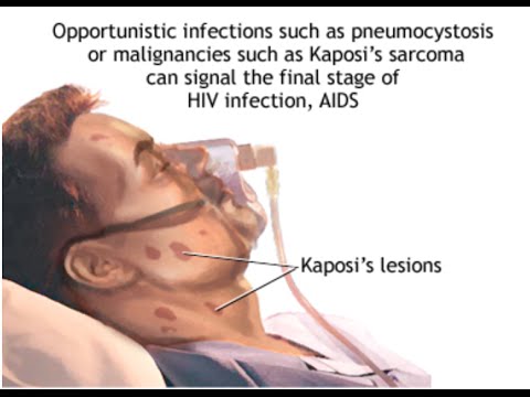 Pneumocystis