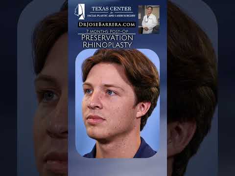 Video thumbnail: ✨ 7 Months Post-Op | Advanced Preservation Rhinoplasty ✨