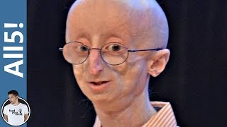 5 Real Strange Genetic Mutations!