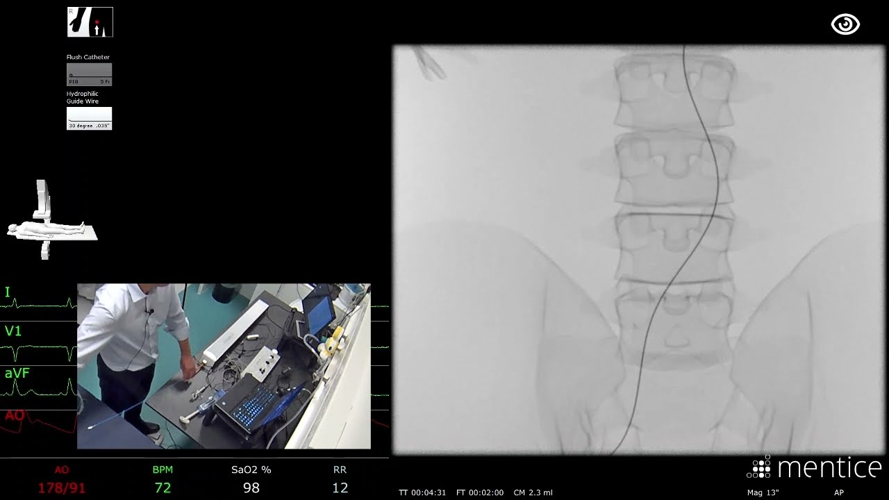 Ipsilateral Common Iliac Angioplasty - Dr David Brophy