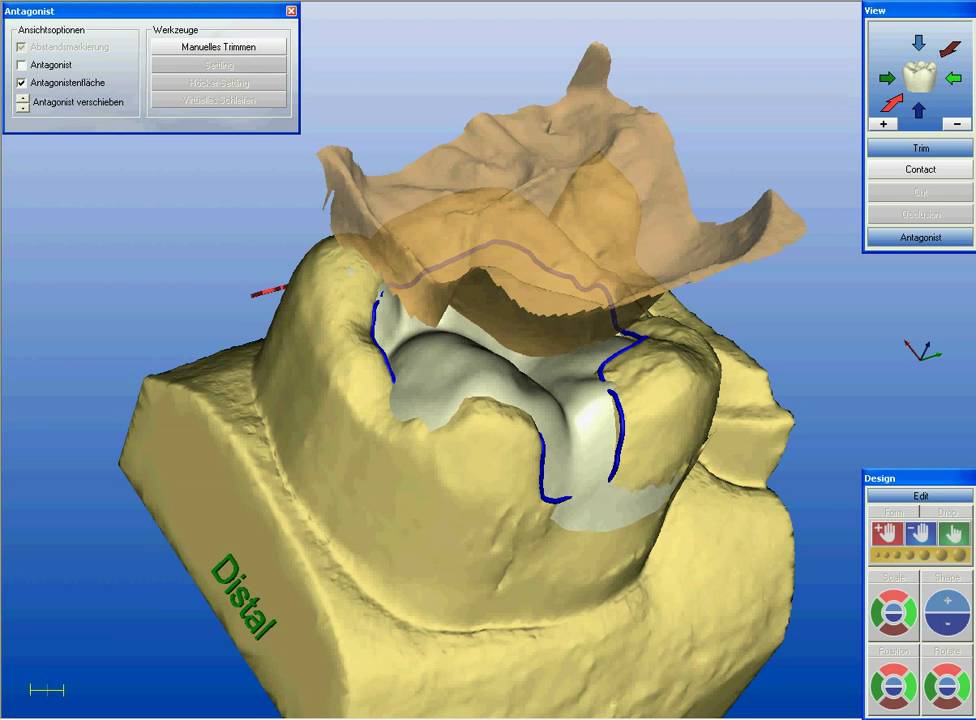 Making of an inlay (CEREC)