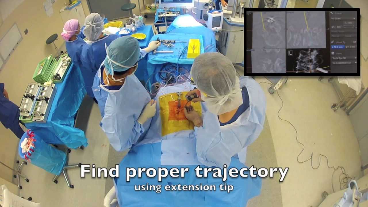 Percutaneous Pedicle Screw Fusion STRYKER ES2 Dr Ralph Mobbs YouTube