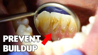 How to Prevent Buildup on Bottom Front Teeth Resimi