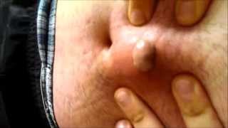 Infected Ingrown Hair