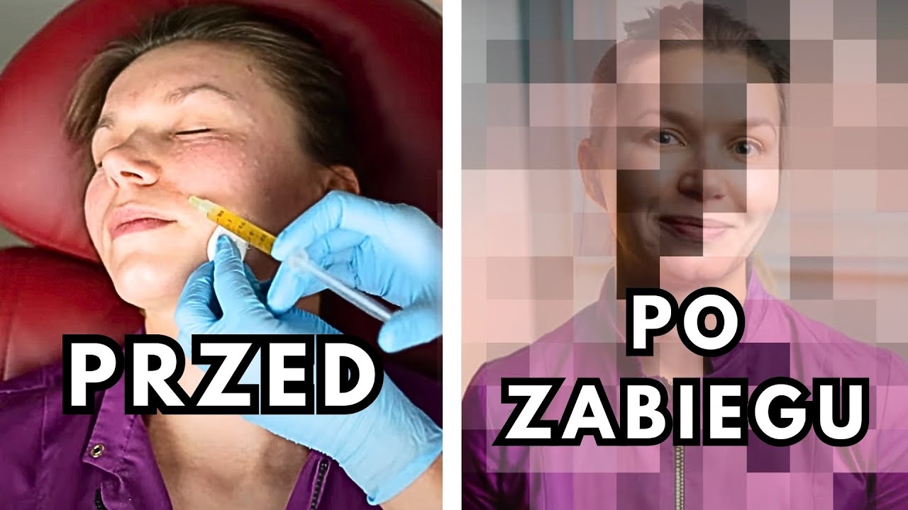 🩸 Ostrzykiwanie osoczem: Tak Wygląda WAMPIRZY LIFTING