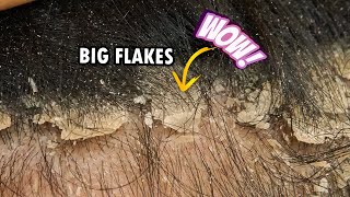 Picking Big Scalp Flakes Psoriasis!!! Dandruff Scratching Satisfying #301