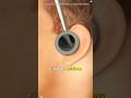 Tympanic Membrane Perforation Treatment (3D Animation)#eardrumperforation #eardrumrepair