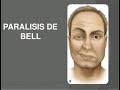 Parálisis de Bell - (Parálisis facial) TERAPIA