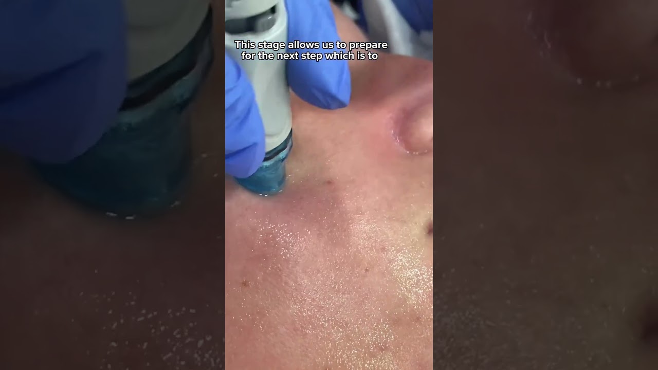 THE IMPORTANT STAGE in Hydrafacial | Dr. Medispa