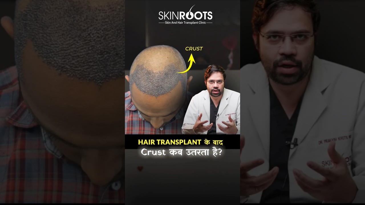 When do crusts fall off after a hair transplant? Explained by Dr. Prakash Khute | Skinroots Clinic