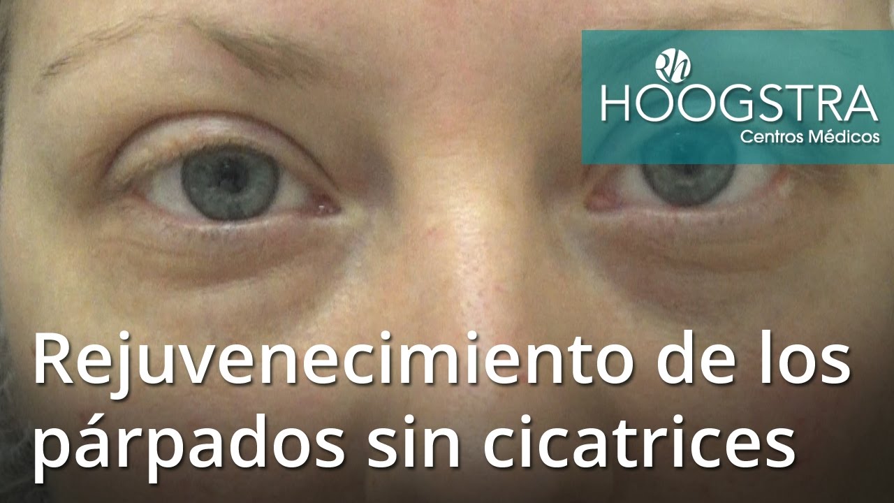 eyelid surgery Rejuvenecimiento de los párpados sin cicatrices (16123)