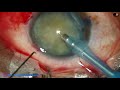Intumescent cataract : Rhexis runs out ... what to do now..  Pradip Mohanta, 24th June, 2020