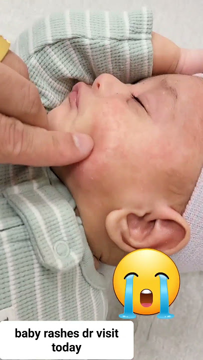 Day 76 - Baby rashes on face - love and we