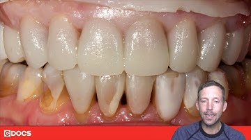 Tip of the Day: Correctly Preparing Anterior Teeth