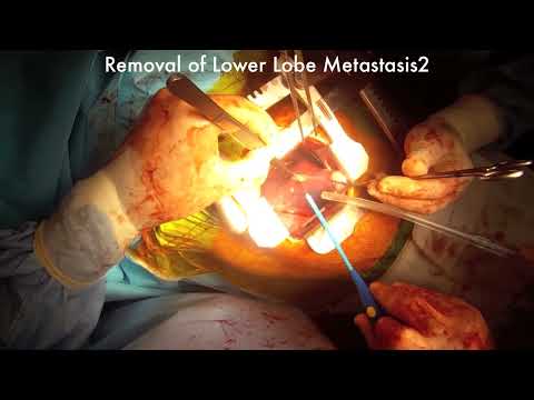Akciğer Metastaz Ameliyatı